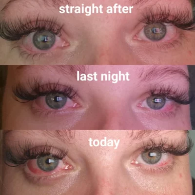 redness-due-to-allergic-reaction-to-lash-glue