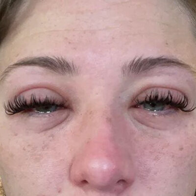 Burning-and-stinging-after-eyelash-extensions-allergic-reaction-to-lash-extension
