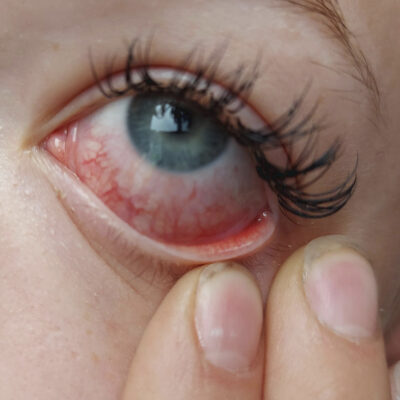 bloodshots-eyes-after-eyelash-extension-lash-extension-irriations