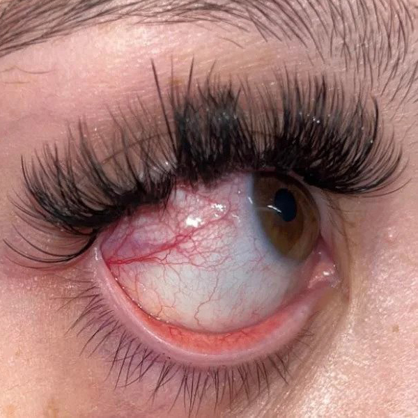 Reasons why you got lash extension allergy & how to treat it