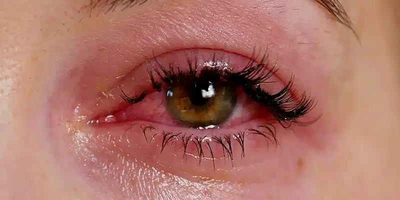 allergic reaction to lash glue