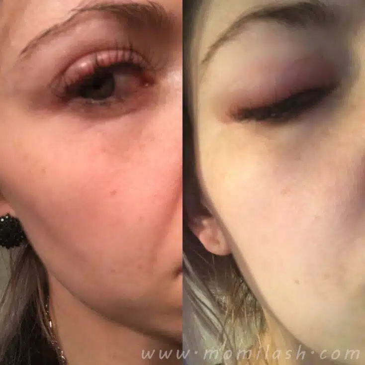 Allergic to Eyelash Glue: A Comprehensive Guide allergic to eyelash adhesive