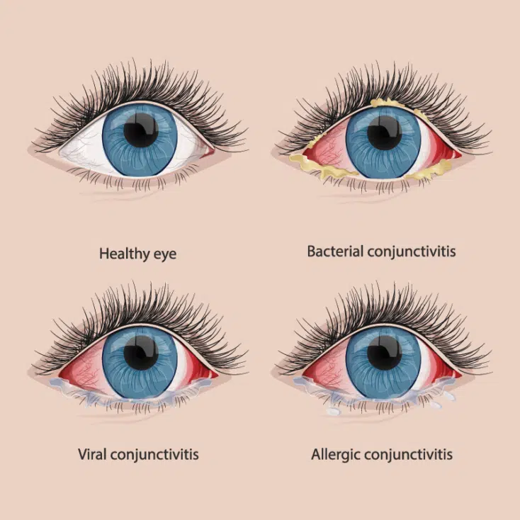 The ultimate guide on lash extension infection Conjunctivitis