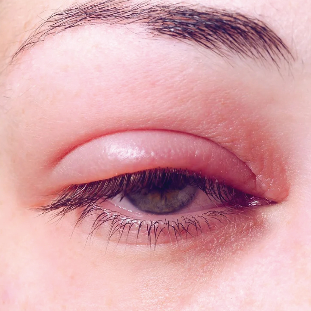 lash-extension-infection