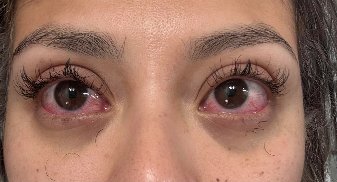  irritation-after-removing-lash-extensionss-at-home